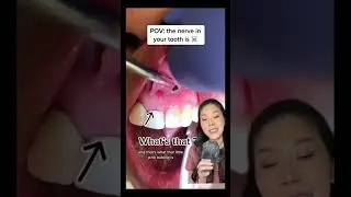 What happens when the nerve inside a tooth dies? #nerve #teeth #cavity #dentistry #dentalvideo