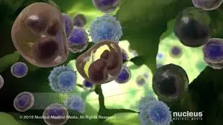 What is Lymphoma?