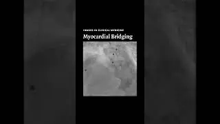 Myocardial Bridging | NEJM
