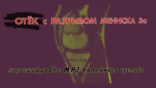 ОТЁК коленного сустава с РАЗРЫВОМ МЕНИСКА 3 степени по stoller на РАСШИФРОВКЕ МРТ коленного сустава