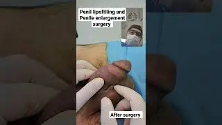 Penil lipofilling and Penile enlargement surgery results after surgery Dr Araz Bayramov 