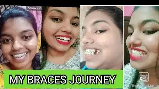 MY BRACES JOURNEY/MY BRACES EXPERIENCE/BRACES COST/BRACES PRICE #braces #bracesjourney #bracecost