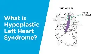 What is Hypoplastic Left Heart Syndrome?