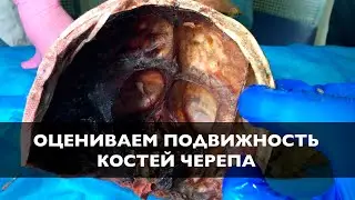 Оцениваем подвижность костей черепа