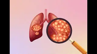 Understanding ALK+ Lung Cancer