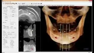 Cone Beam CT Interpretation for Zest LODI Implants by Robert Chen