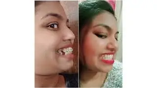 Braces Before/After Journey #braces #ortho #trending #trendingvideo #ytshorts #shorts #shortvideo