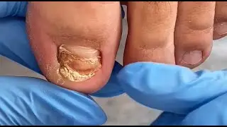 Отдавленные ногти