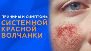 ПРИЧИНЫ И СИМПТОМЫ СИСТЕМНОЙ КРАСНОЙ ВОЛЧАНКИ // #zdravclinic