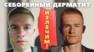 Себорейный дерматит  Как я избавился от себореи с помощью питания и натуральной косметики