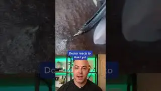 Derm reacts to very hairy cyst removal! 
