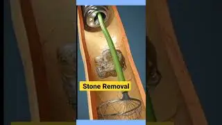 3D Key Hole Stone Removal | 