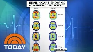 Alzheimer’s Breakthrough: Study Shows New Drug Slows Memory Loss | TODAY