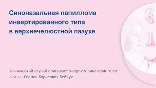 Синоназальная папиллома инвертированного типа в верхнечелюстной пазухе справа