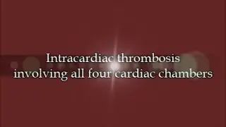 Intracardiac Thrombosis Involving All Four Cardiac Chambers