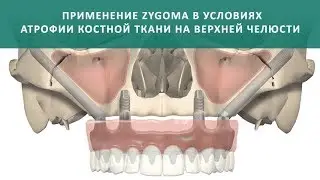 Скуловая имплантация Зигома (Nobel Zygoma)