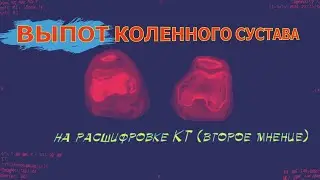 ЖИДКОСТЬ В КОЛЕНЕ после травмы, ПЕРЕЛОМ МЫЩЕЛКА большеберцовой кости на РАСШИФРОВКЕ КТ второе мнение