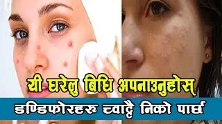 यी घरेलु बिधि अपनाउनुहोस् डण्डिफोर च्वाट्टै निको पार्छ | Methods to cure Pimples immediately