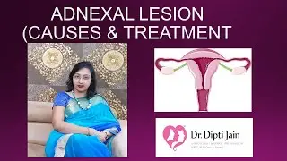 ADNEXAL LESION (CAUSES & TREATMENT)