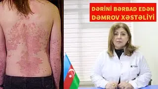 ÇƏHRAYI DƏMROV VƏ ALABƏZƏK DƏMROV DƏRİ XƏSTƏLİYİ