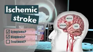 Ischemic Stroke Animation | Symptoms, diagnosis, treatment & prognosis