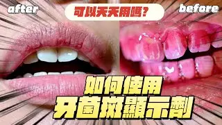 什麼是牙菌斑顯示劑｜Dr.Wells