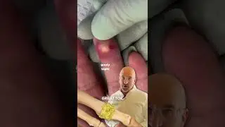 Common Cause of Painful Big Toe 