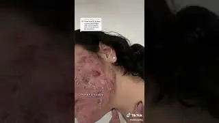 Dəri altı gənə xəstəliyi 🙄