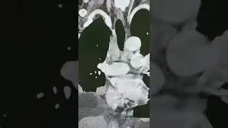 Метастазы рака лёгкого в лимфоузлах средостения.