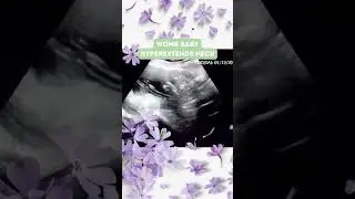 Incredible Womb Baby Hyperextends Neck in Uterus!😱#shorts