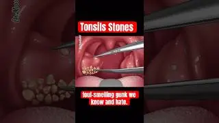 TONSILS STONES, TONSILLITIS