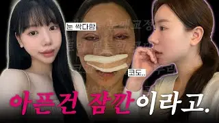 왜 다들 내 영상만 보면 성형외과를 가는지 모르겠어💦| 눈매교정 + 뒤밑트임 + 코수술
