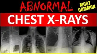 Abnormal Chest X-ray Interpretation 