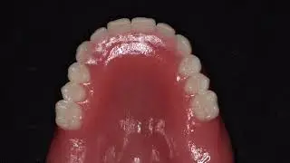 Better Denture Conversions