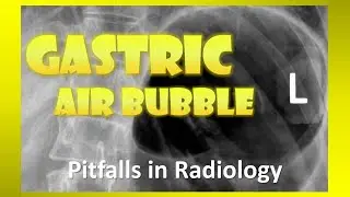 Gastric Air Bubble - Pitfalls in Radiology