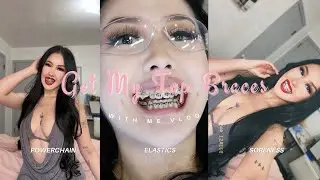 BRACES VLOG EP.6: 4 MONTHS with bottom braces + GETTING MY TOP BRACES TODAY!! | Ortho Vlog🦷🪥