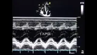 M-mode tracing of MAPSE & TAPSE