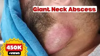 Giant Neck Abscess || An immediate improvement after pus aspiration || Lymph nodes and Cold Abscess