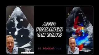 Echocardiography Findings in Atrial Fibrillation (Afib)