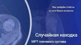 МРТ плечевого сустава. Случайная находка
