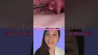 It’s a tonsil stone parade! 