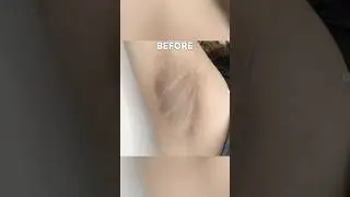 You Won’t Believe This Underarm Transformation! 😲 