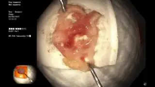 Serrated adenoma. NBI and acetic acid chromoscopy