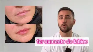 Cómo conseguir unos labios perfectos con ácido hialurónico