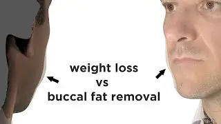 Nonsurgical Facial Slimming - Buccal Fat Reduction?  Dr. Zelken offers a surprisingly simple answer