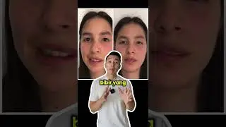 CARA MENGOBATI PENYAKIT BELLS PALSY | OBAT BELLS PALSY 