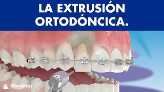 Extrusión ortodóncica ©
