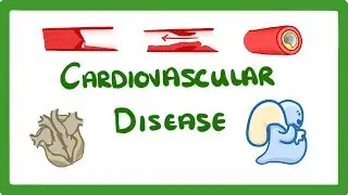 GCSE Biology - Why Do We Get Heart Disease and How to Treat It? - Cardiovascular Disease (CVD)  #47