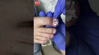 Вросший ноготь / Педикюр / Тампонада 