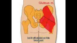 Gluteus maximus separation
